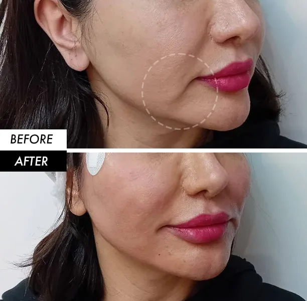 Aptos thread lift before and after in Dubai by Dr. Azra Vaziri — lifted lower face and jawline