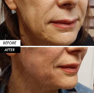 Before-After Biostimulator copy Before-After Biostimulator copy