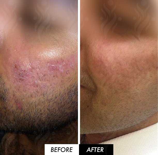 before after microneedling before after microneedling