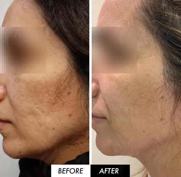 Before and after body skin booster treatment by Dr Azra Vaziri in Dubai
