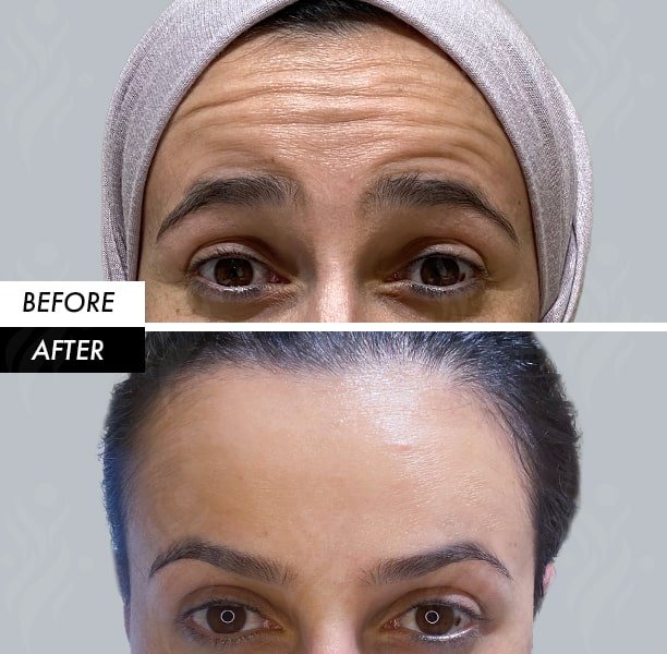 botox
