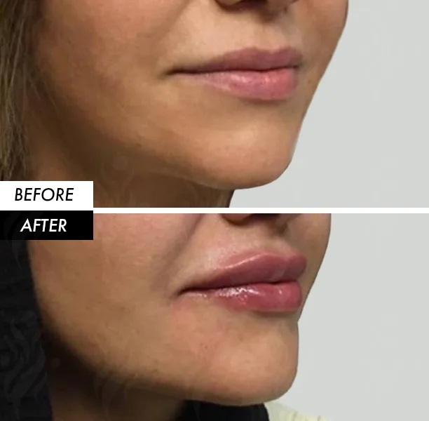 lip filler