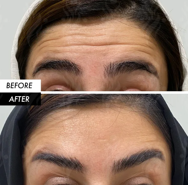 Forehead Botox before and after in Dubai by Dr. Azra Vaziri — deep horizontal forehead lines relaxed