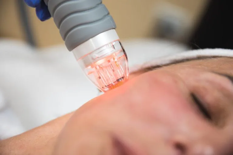 RF microneedling for acne scars at Dr Azra Clinic, Dubai