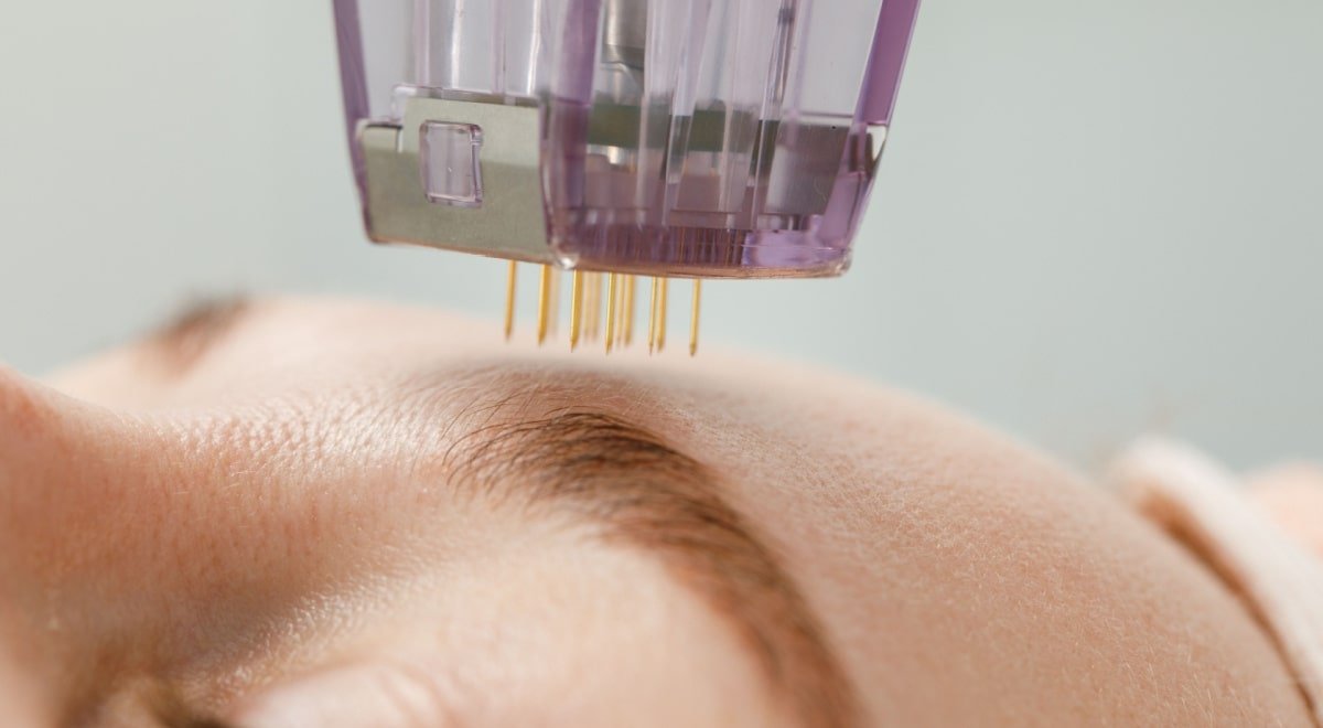 Radiofrequency Fractional Needling Radiofrequency Fractional Needling