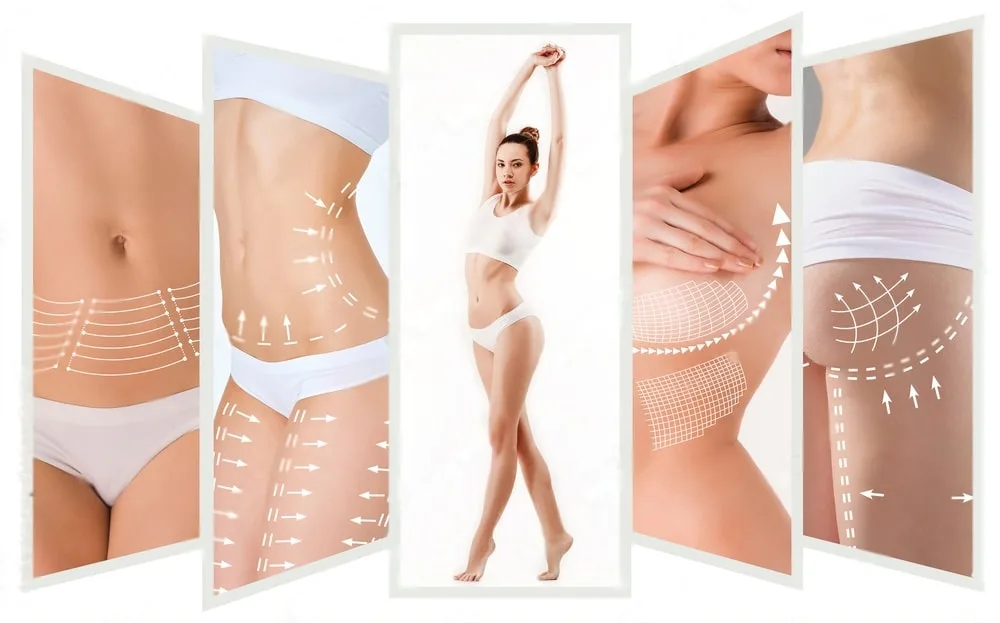 Treatment areas marked on the skin before a cellulite and body contouring session in Dubai