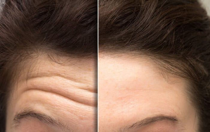 face of a woman before and after a botox treatment to smooth expression lines. Concept of anti-aging and rejuvenation cosmetics on forehead wrinkles-min