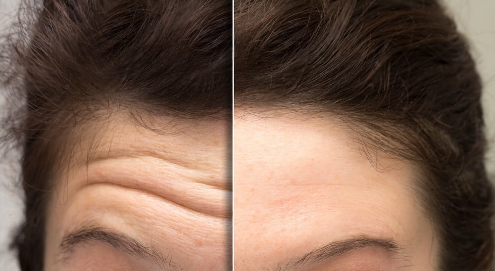 face of a woman before and after a botox treatment to smooth expression lines. Concept of anti-aging and rejuvenation cosmetics on forehead wrinkles-min