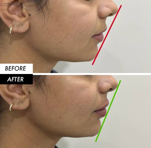 lip and chin filler