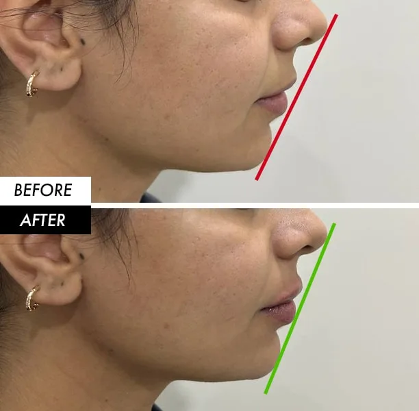 Chin filler before and after in profile by Dr. Azra Vaziri in Dubai — improved chin projection