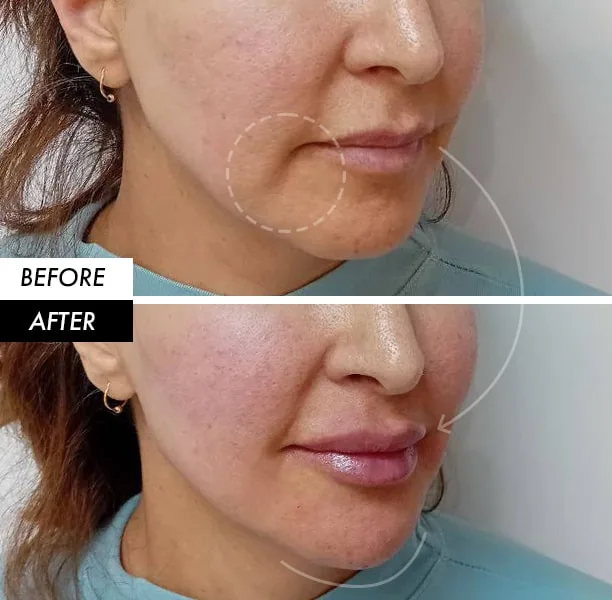 Lip filler before and after in Dubai by Dr. Azra Vaziri — fuller lips and a softened downturned mouth corner