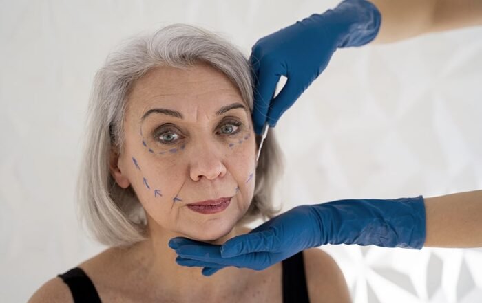Non-Surgical Thread Lifting