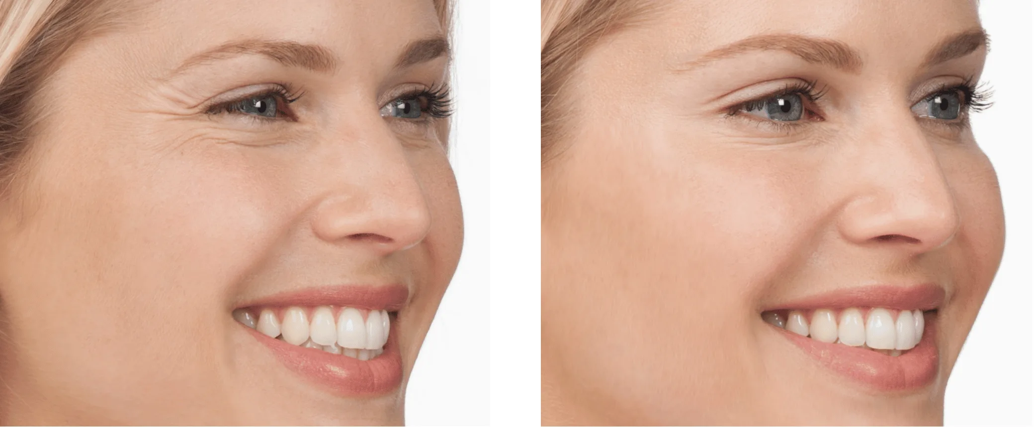 Crow's Feet Botox in Dubai by Dr Azra Vaziri