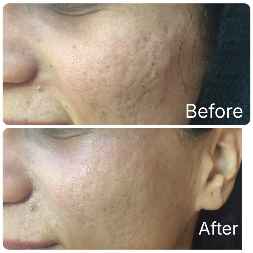 Dermapen microneedling before and after in Dubai by Dr. Azra Vaziri &mdash; smoother, more even skin