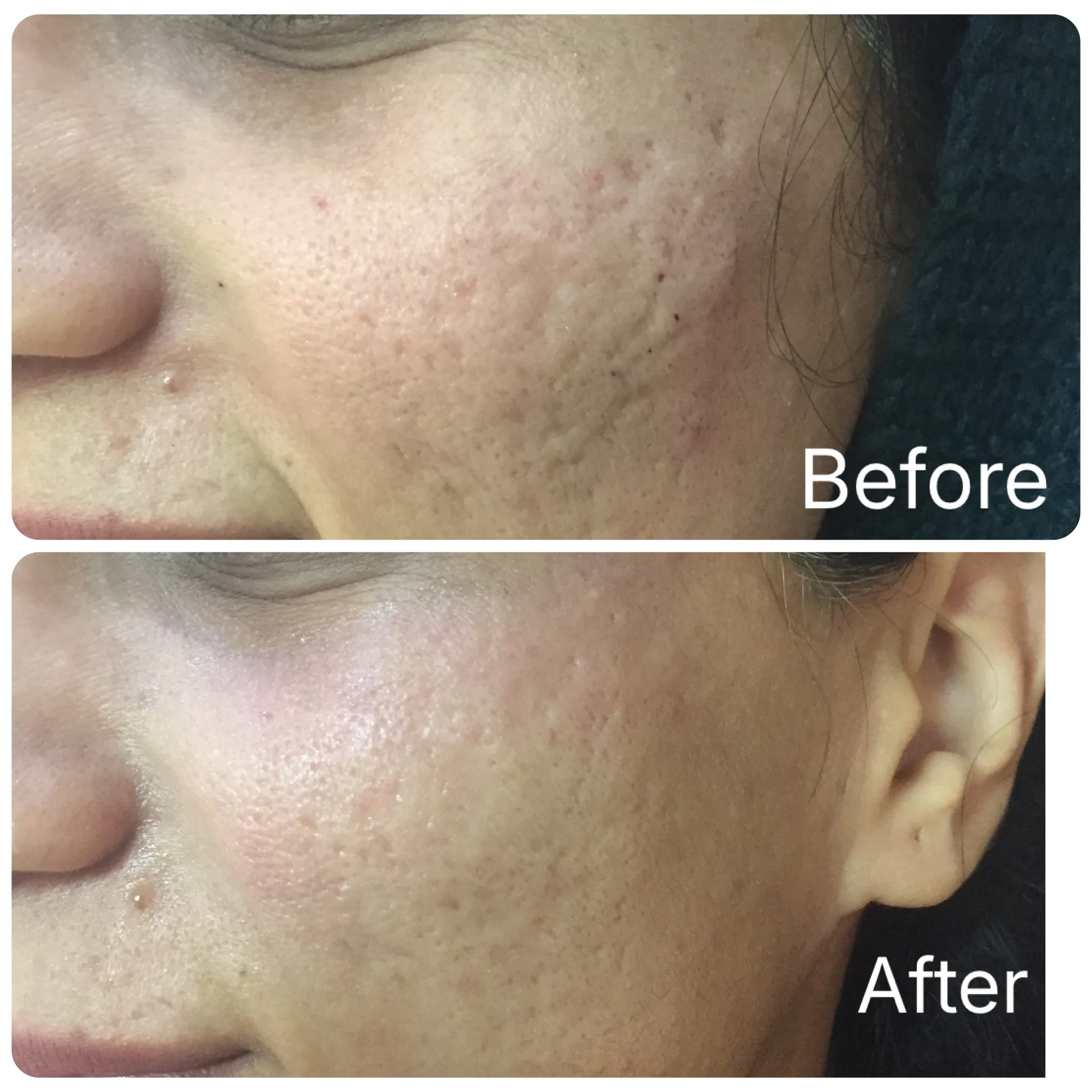 Dermapen microneedling before and after result by Dr Azra Vaziri, Dubai