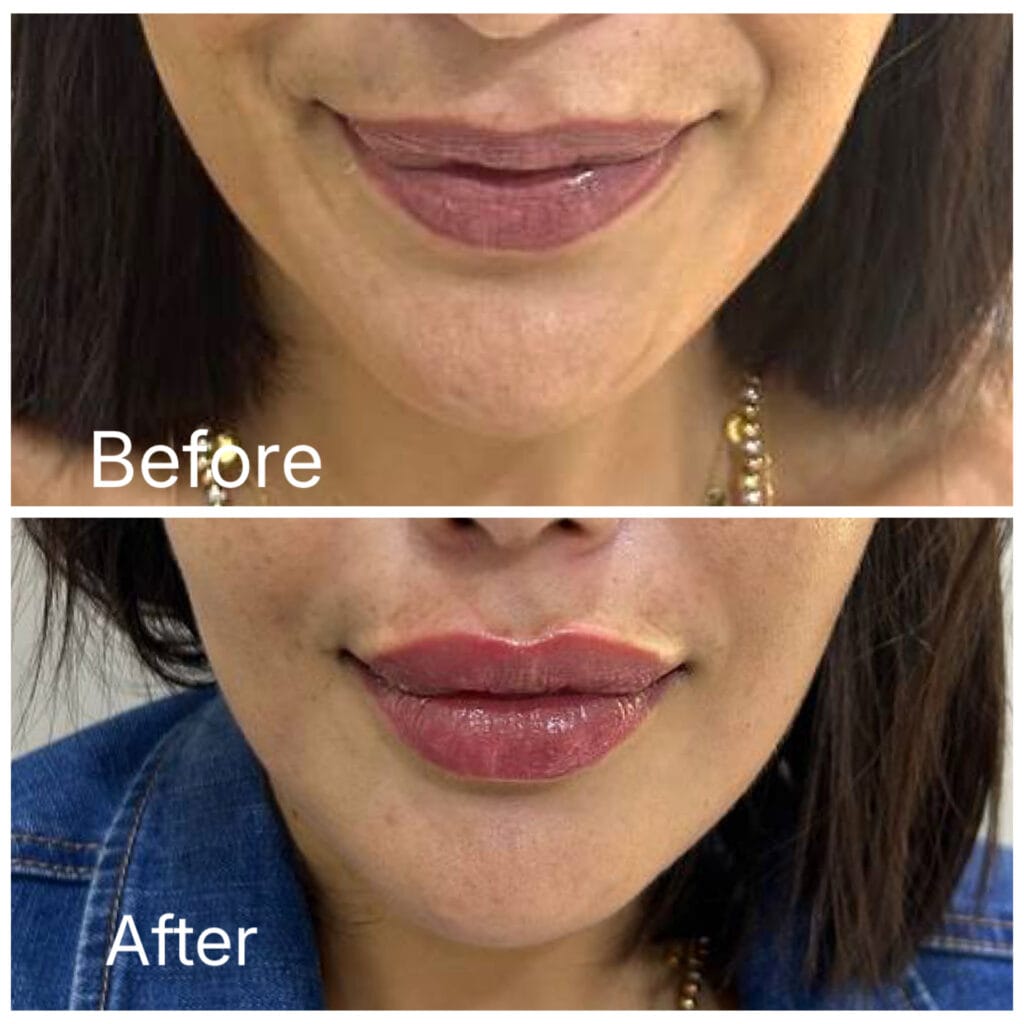 Lip filler and lip augmentation before and after in Dubai by Dr. Azra Vaziri