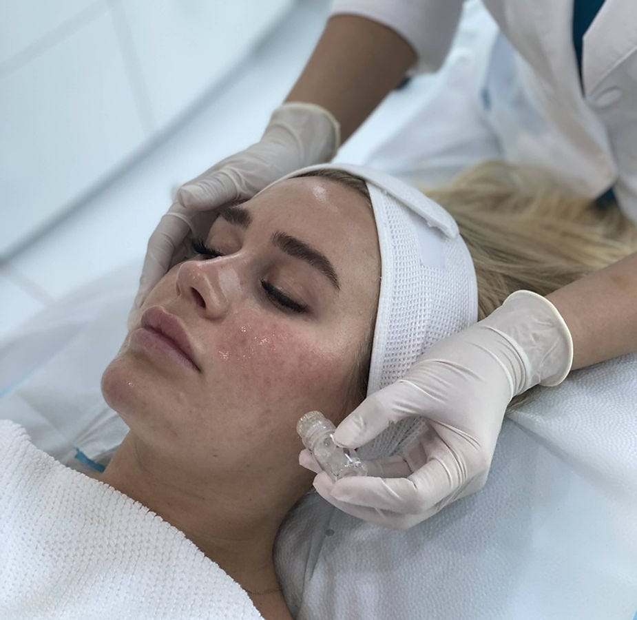 Mesotherapy being delivered as a grid of superficial micro-injections across the cheek, the technique Profhilo does not use