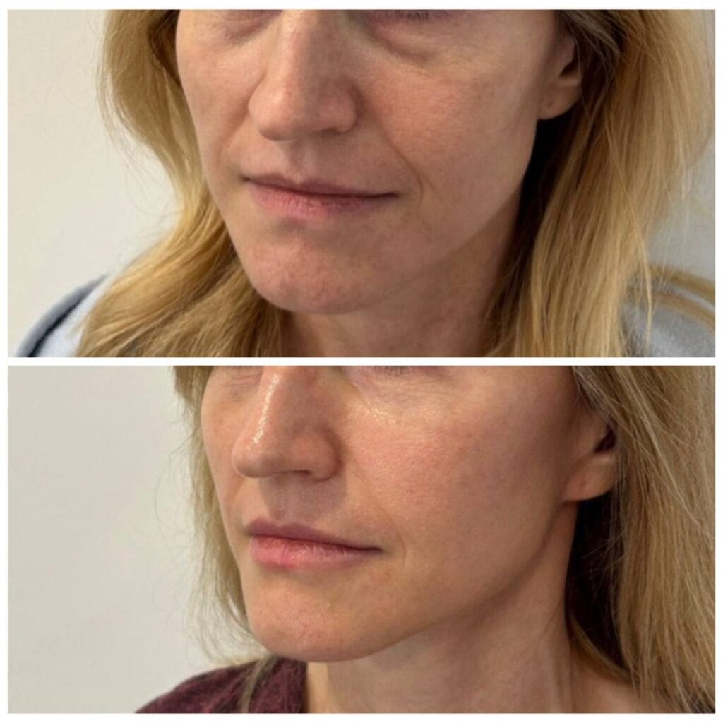 Full face filler before and after in Dubai by Dr. Azra Vaziri &mdash; lower face and lips restored