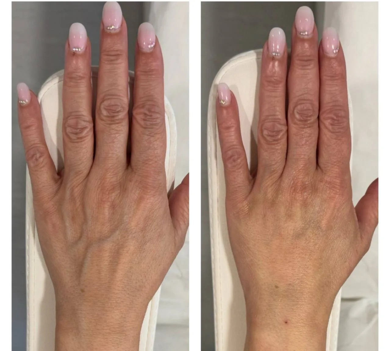 Hand rejuvenation before and after in Dubai — Radiesse restores volume and softens prominent veins, by Dr Azra Vaziri