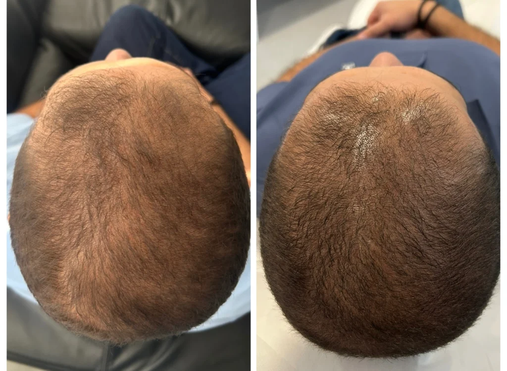 Hair loss treatment before and after in Dubai by Dr. Azra Vaziri — visibly denser crown after scalp microneedling with exosomes