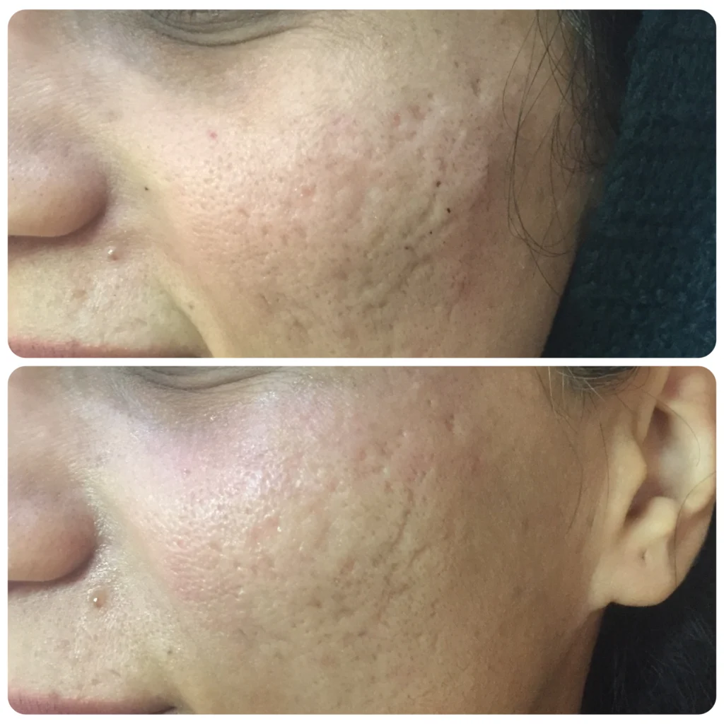 Dermapen microneedling before and after in Dubai by Dr. Azra Vaziri &mdash; acne scarring softened and skin texture evened