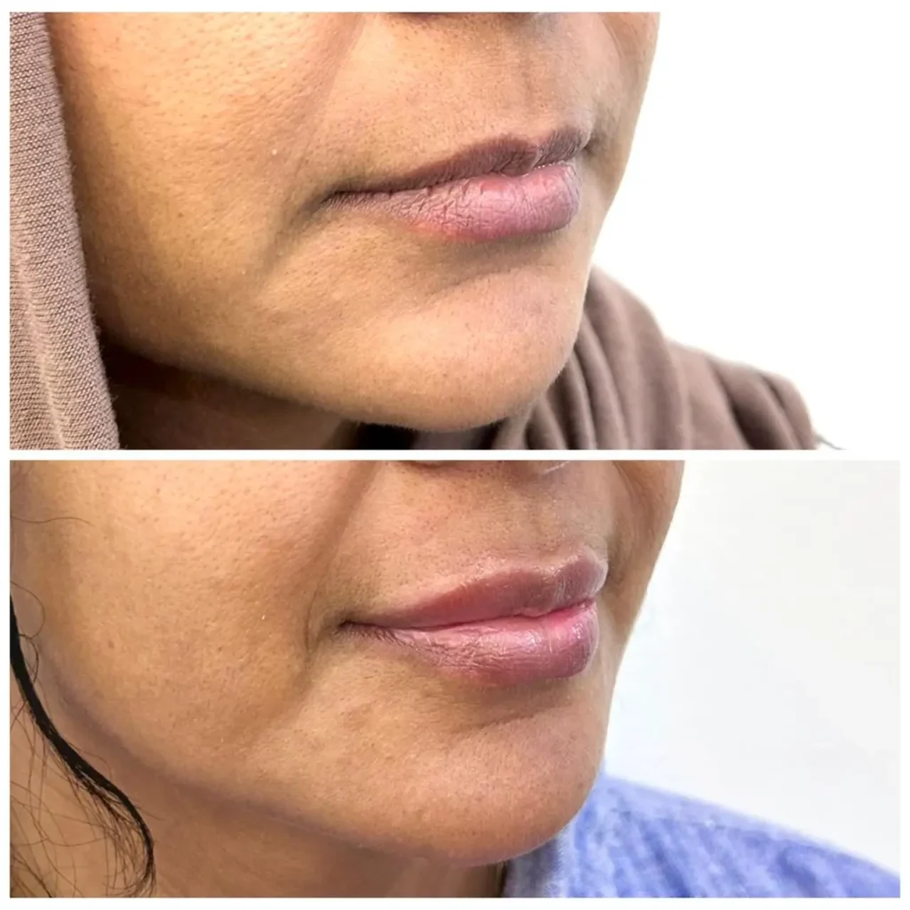 Lip filler before and after by Dr. Azra Vaziri &mdash; refined shape with half a syringe, side view