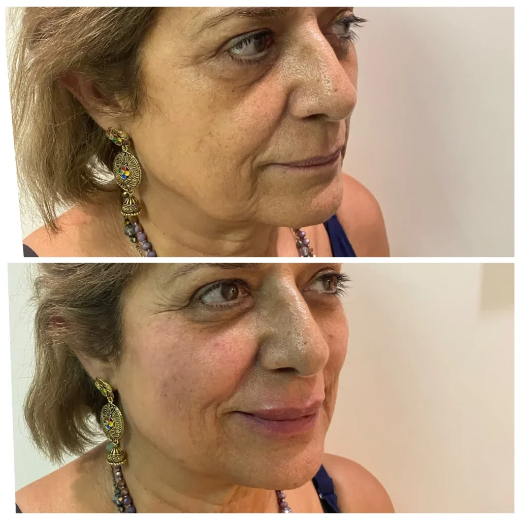 Radiesse before and after in Dubai by Dr. Azra Vaziri &mdash; firmer, fresher lower face with no added volume