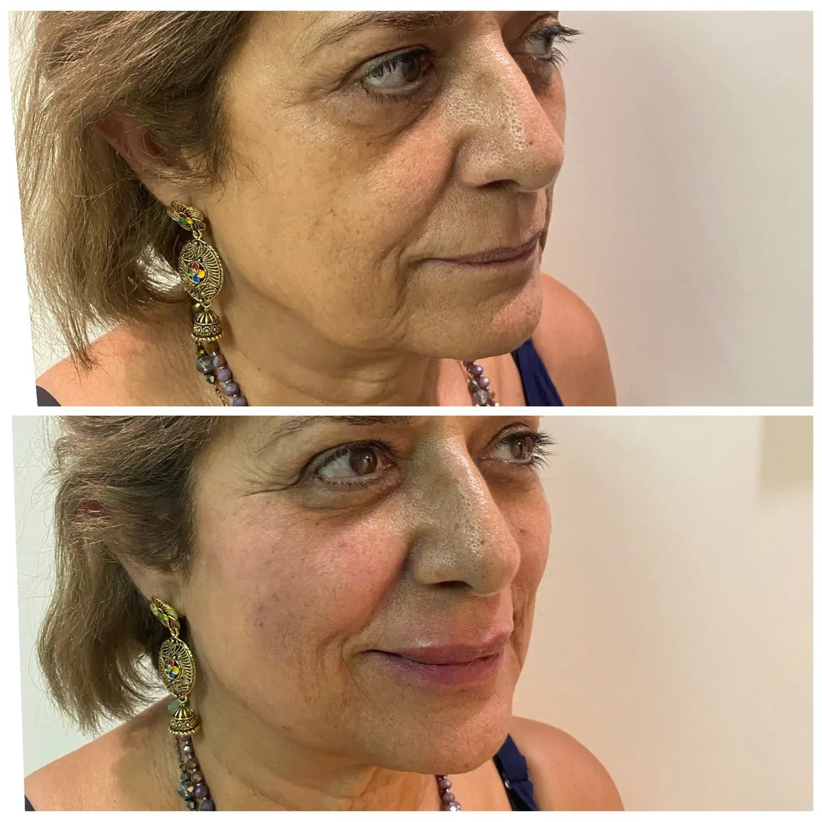 Before and after a restrained Radiesse treatment by Dr. Azra Vaziri, Dubai