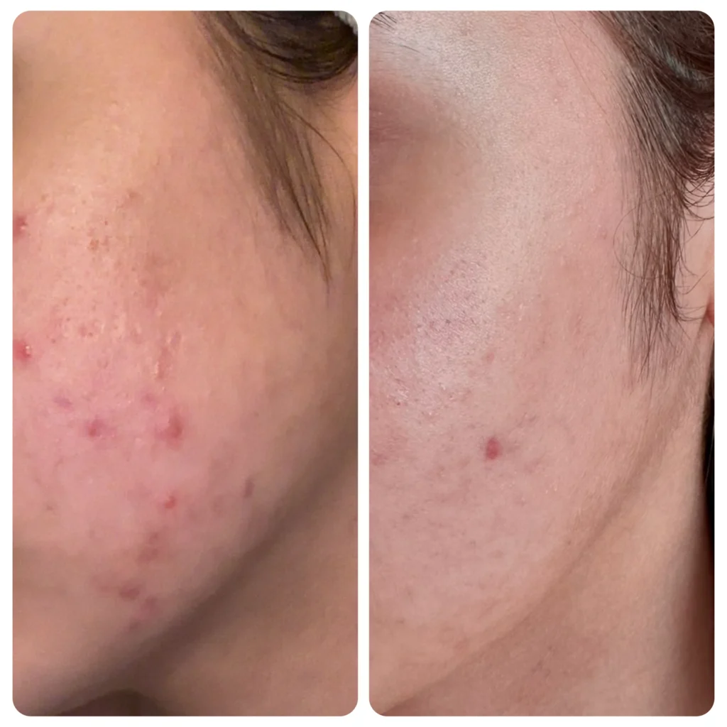 Dermapen before and after in Dubai by Dr. Azra Vaziri — active acne visibly reduced after a microneedling course