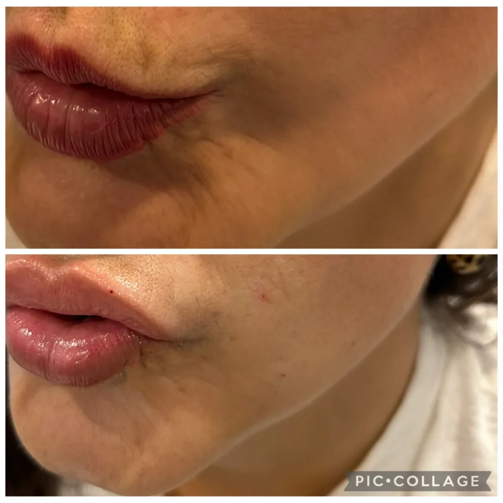 Barcode lines above the lip treated by Dr. Azra Vaziri in Dubai — smoker's lines visibly softened