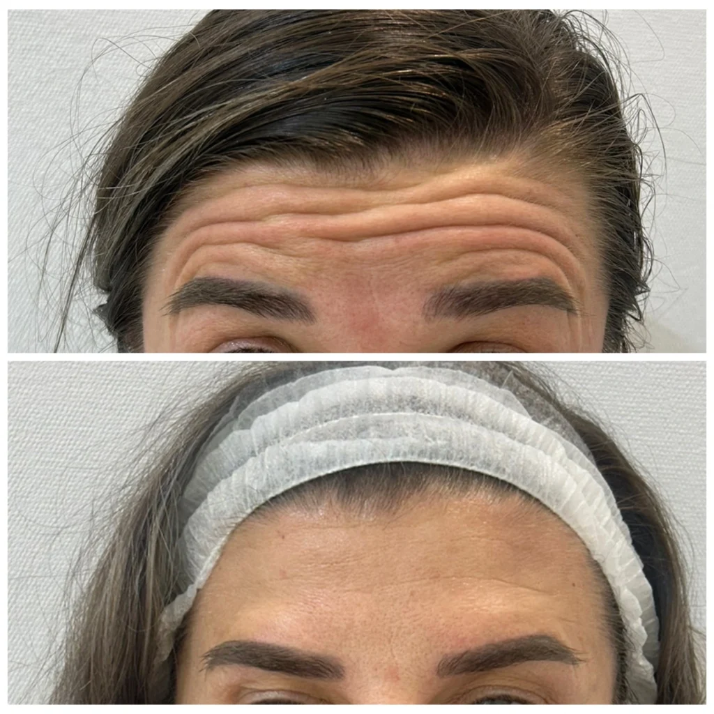 Forehead Botox before and after in Dubai by Dr. Azra Vaziri — deep horizontal forehead lines visibly smoothed