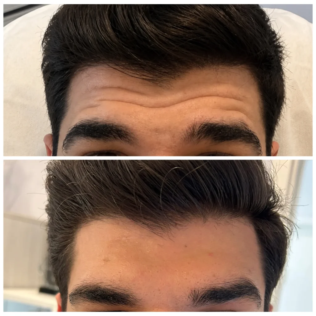 Botox for men before and after in Dubai by Dr. Azra Vaziri — frown and forehead lines softened
