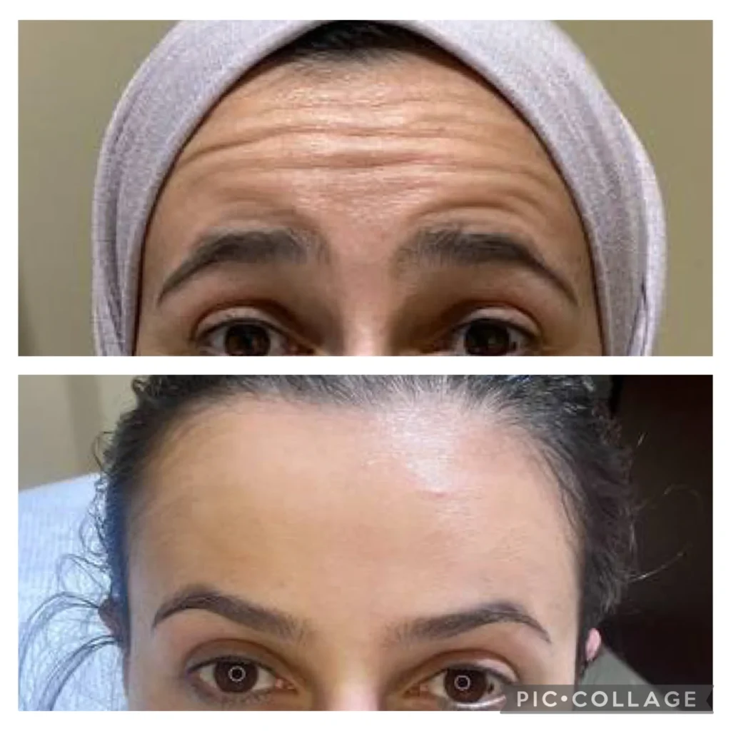 Botox before and after in Dubai by Dr. Azra Vaziri — horizontal forehead lines smoothed