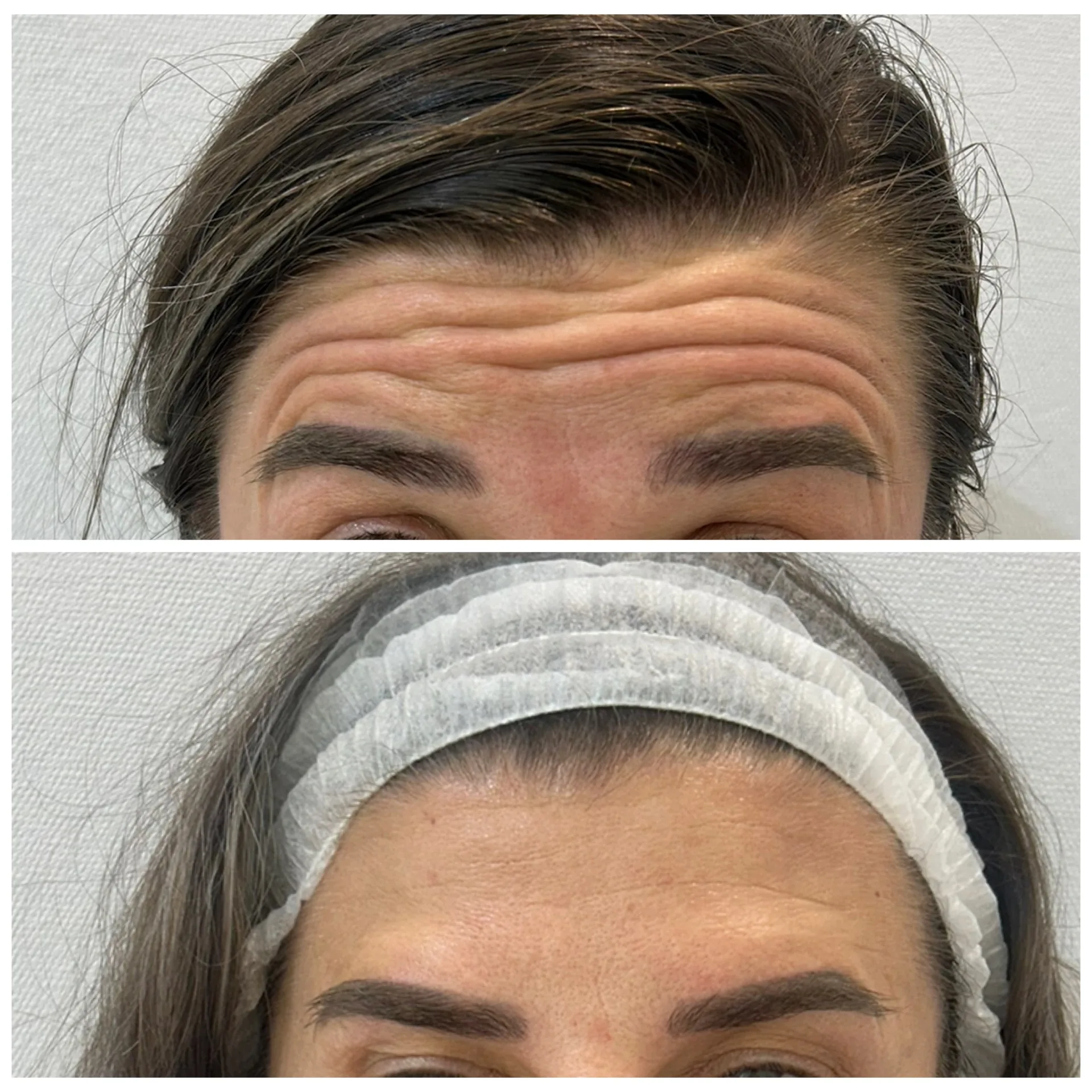 Botox before and after by Dr. Azra Vaziri in Dubai — forehead lines relaxed, natural brow position