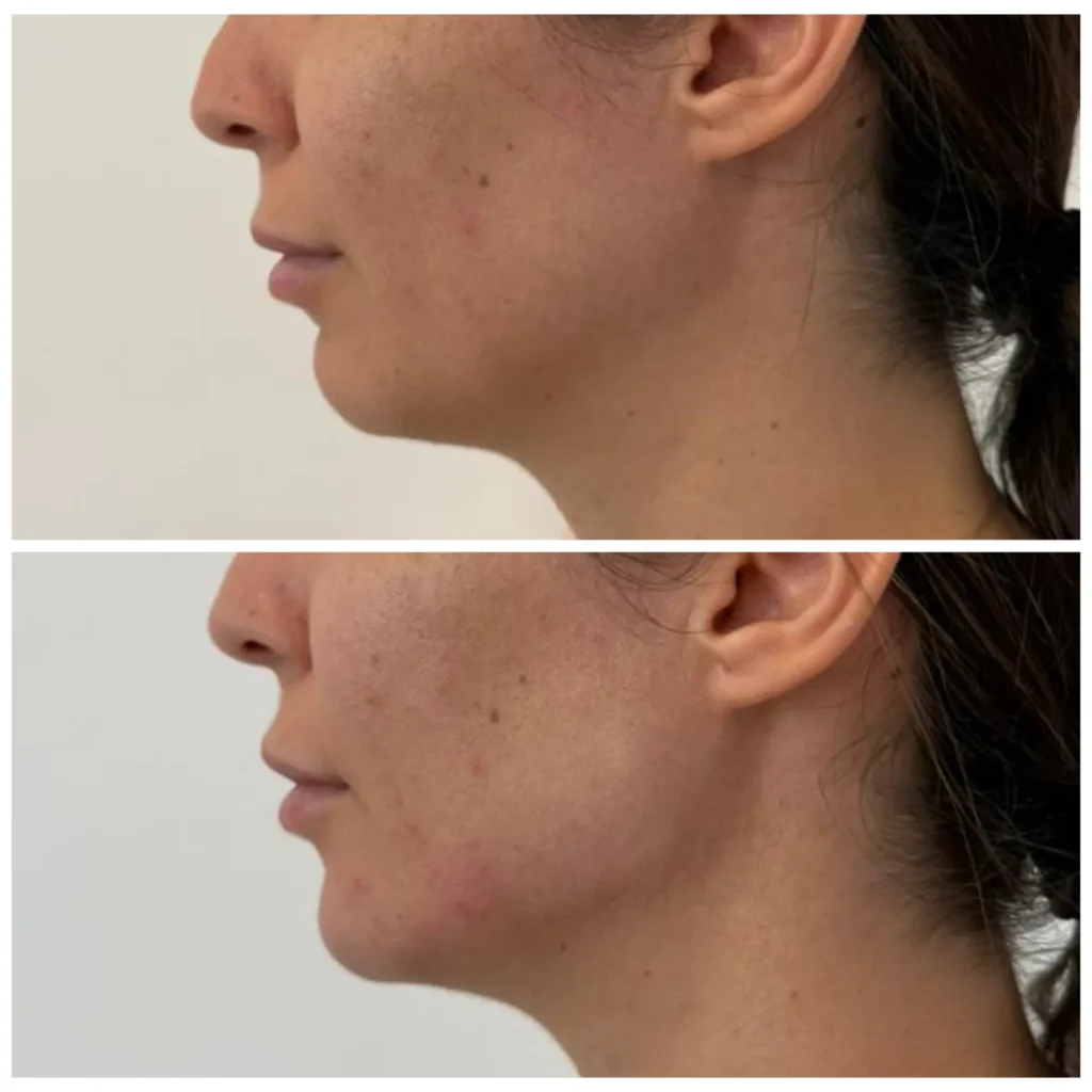 Chin filler before and after in Dubai by Dr. Azra Vaziri — improved chin projection and jaw balance