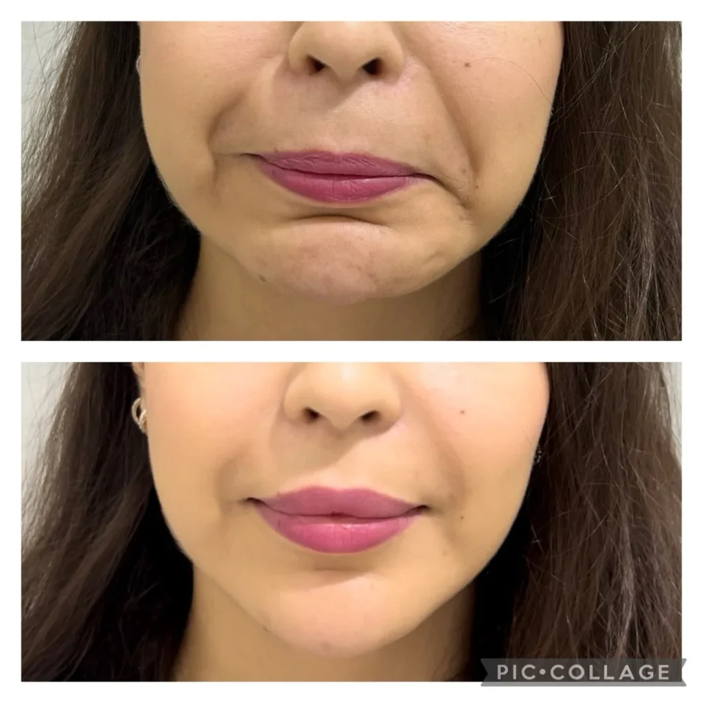DAO Botox before and after in Dubai by Dr. Azra Vaziri — downturned mouth corners lifted