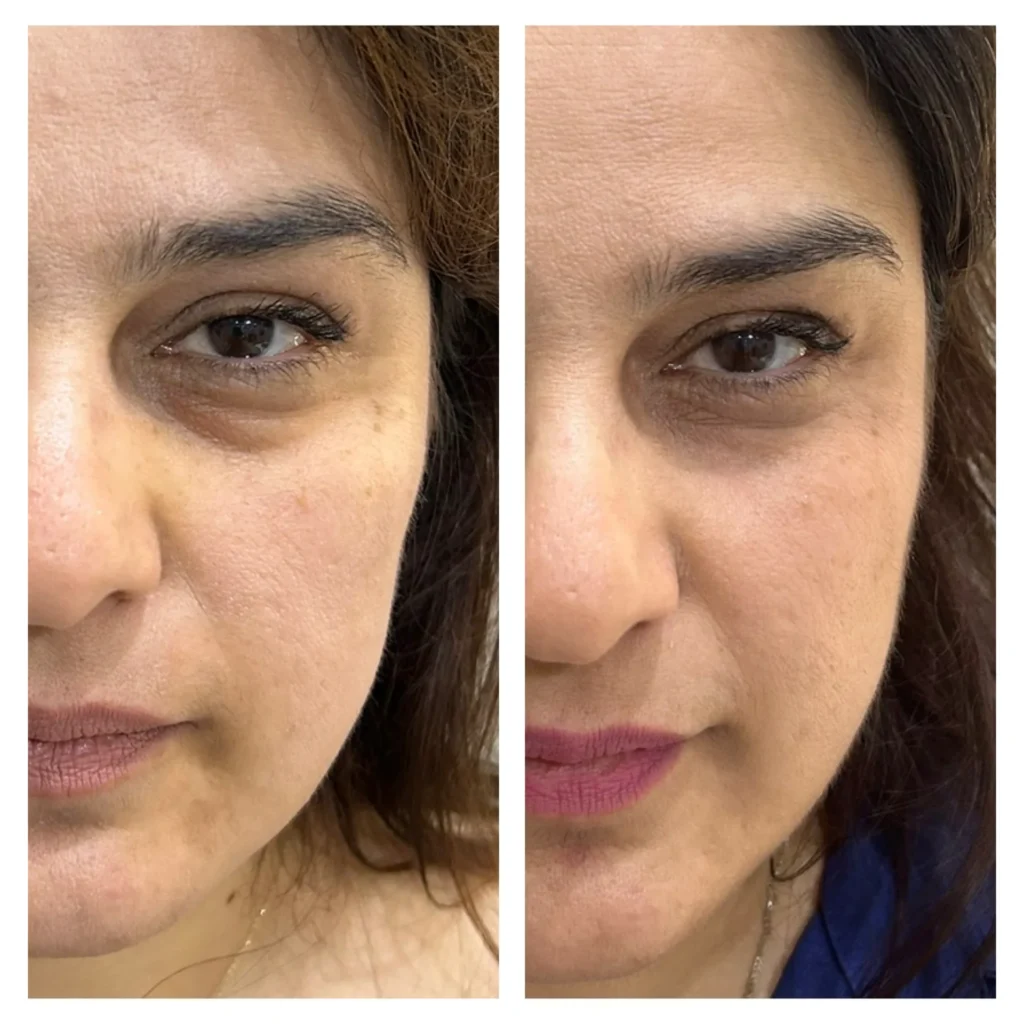 Dark circle booster before and after in Dubai by Dr. Azra Vaziri — brighter under-eye area