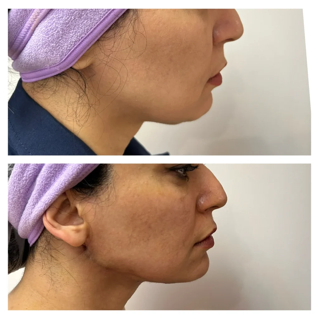 Thread lift of the jawline and under-chin before and after in Dubai by Dr. Azra Vaziri