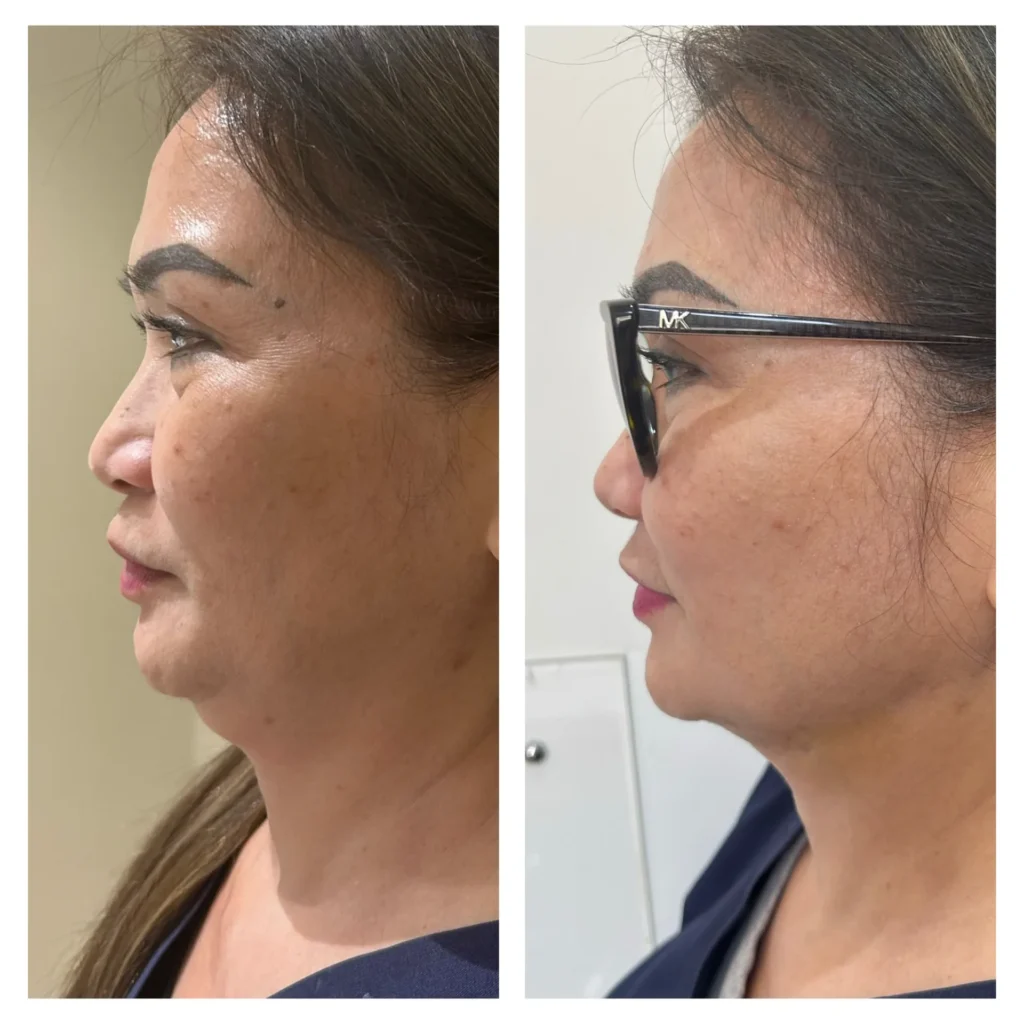Double chin threads before and after by Dr. Azra Vaziri in Dubai &mdash; sharper chin-neck angle