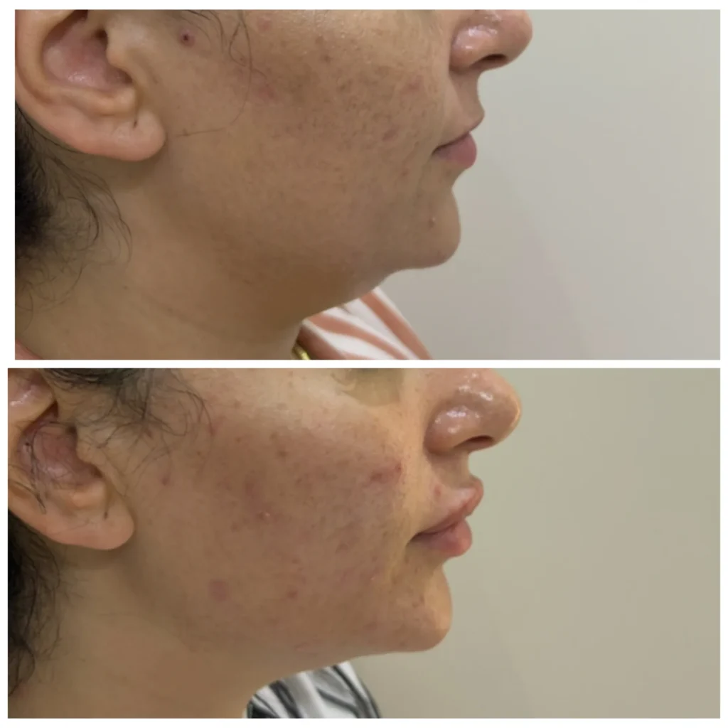 Double chin treatment before and after in Dubai by Dr. Azra Vaziri — reduced fullness under the chin