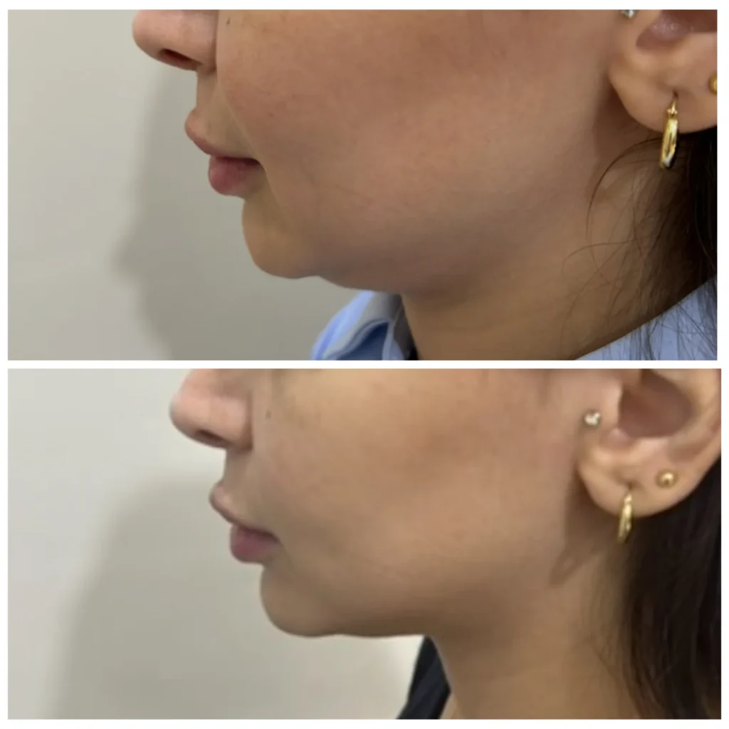 Double chin fat dissolving before and after in Dubai by Dr. Azra Vaziri — fullness under the chin reduced, before (top) and after (bottom)