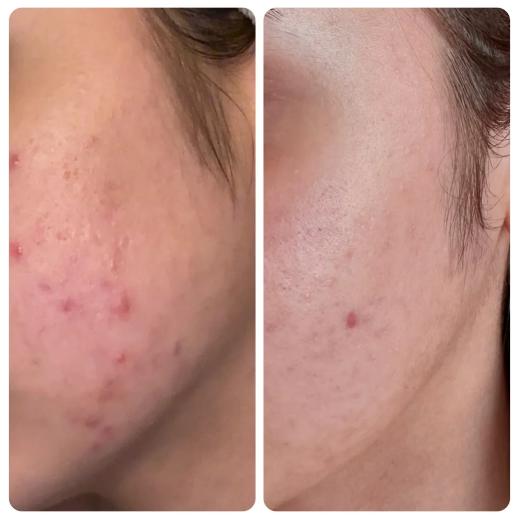 Exosome skin treatment before and after in Dubai by Dr. Azra Vaziri &mdash; clearer, calmer skin