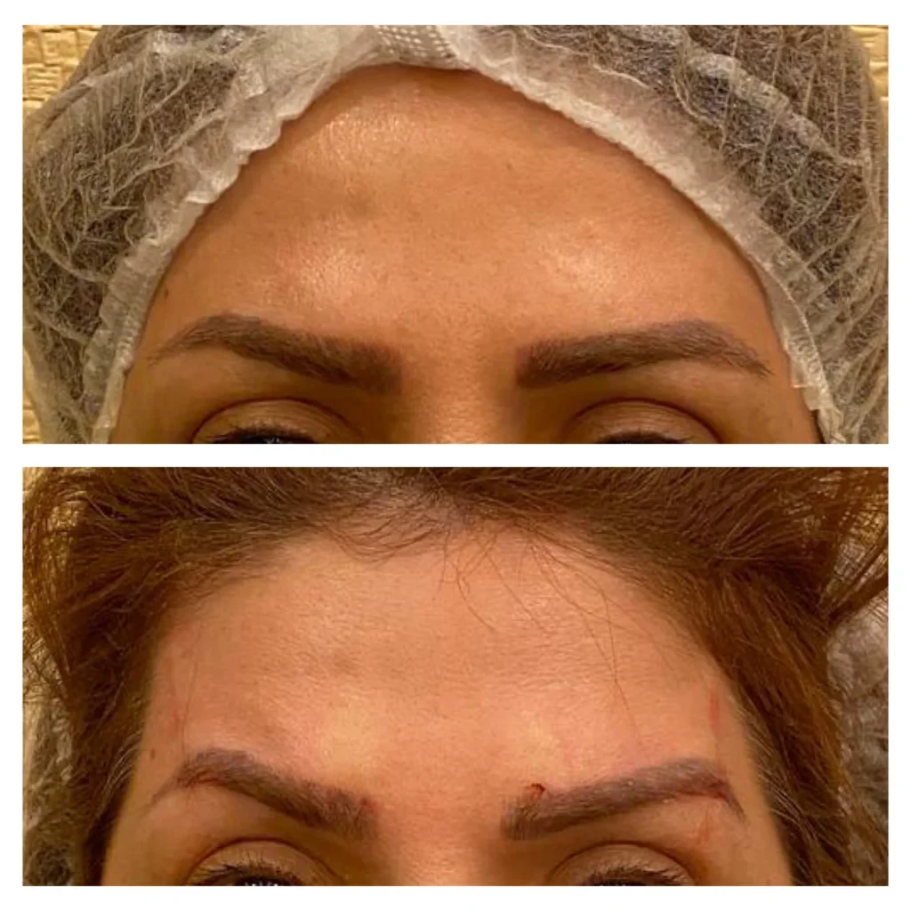 Eyebrow thread lift before and after in Dubai by Dr. Azra Vaziri &mdash; brow position visibly lifted