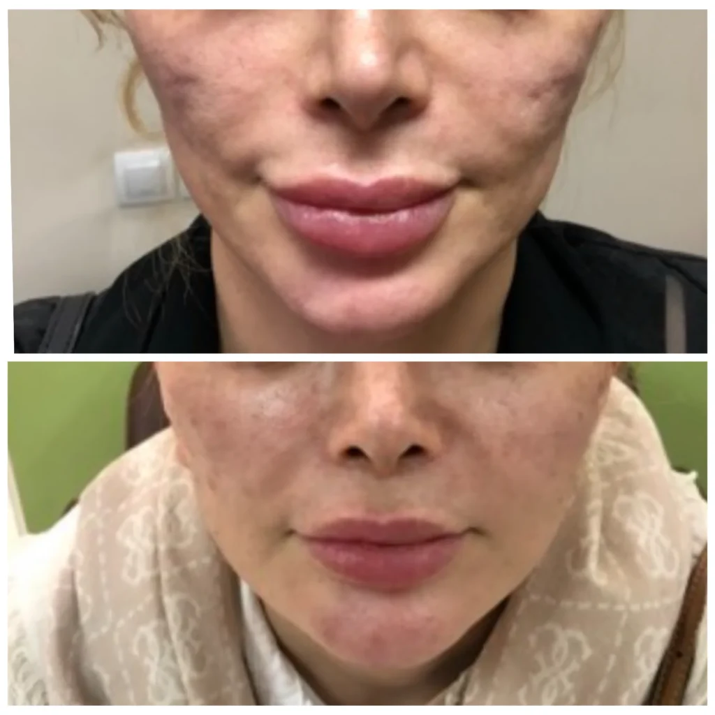 Facial atrophy treatment before and after in Dubai by Dr. Azra Vaziri — lost volume restored naturally