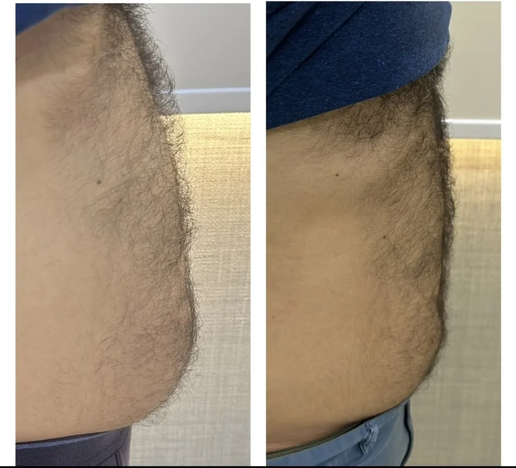 Fat melting injections on the body before and after by Dr. Azra Vaziri in Dubai