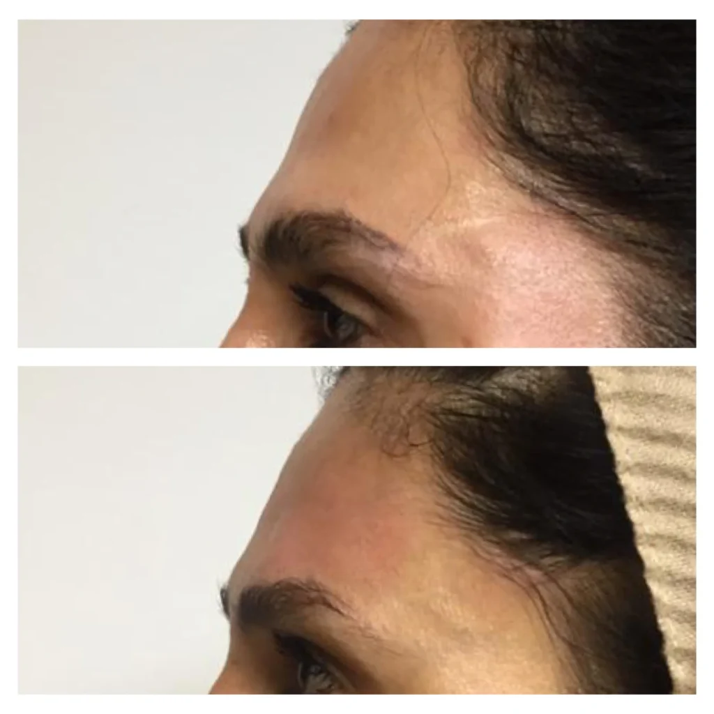 Forehead filler before and after in Dubai by Dr. Azra Vaziri &mdash; smoother forehead contour, profile view