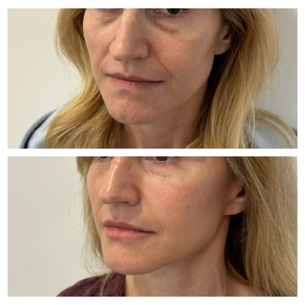 Full face contouring before and after in Dubai by Dr. Azra Vaziri — balanced, natural enhancement