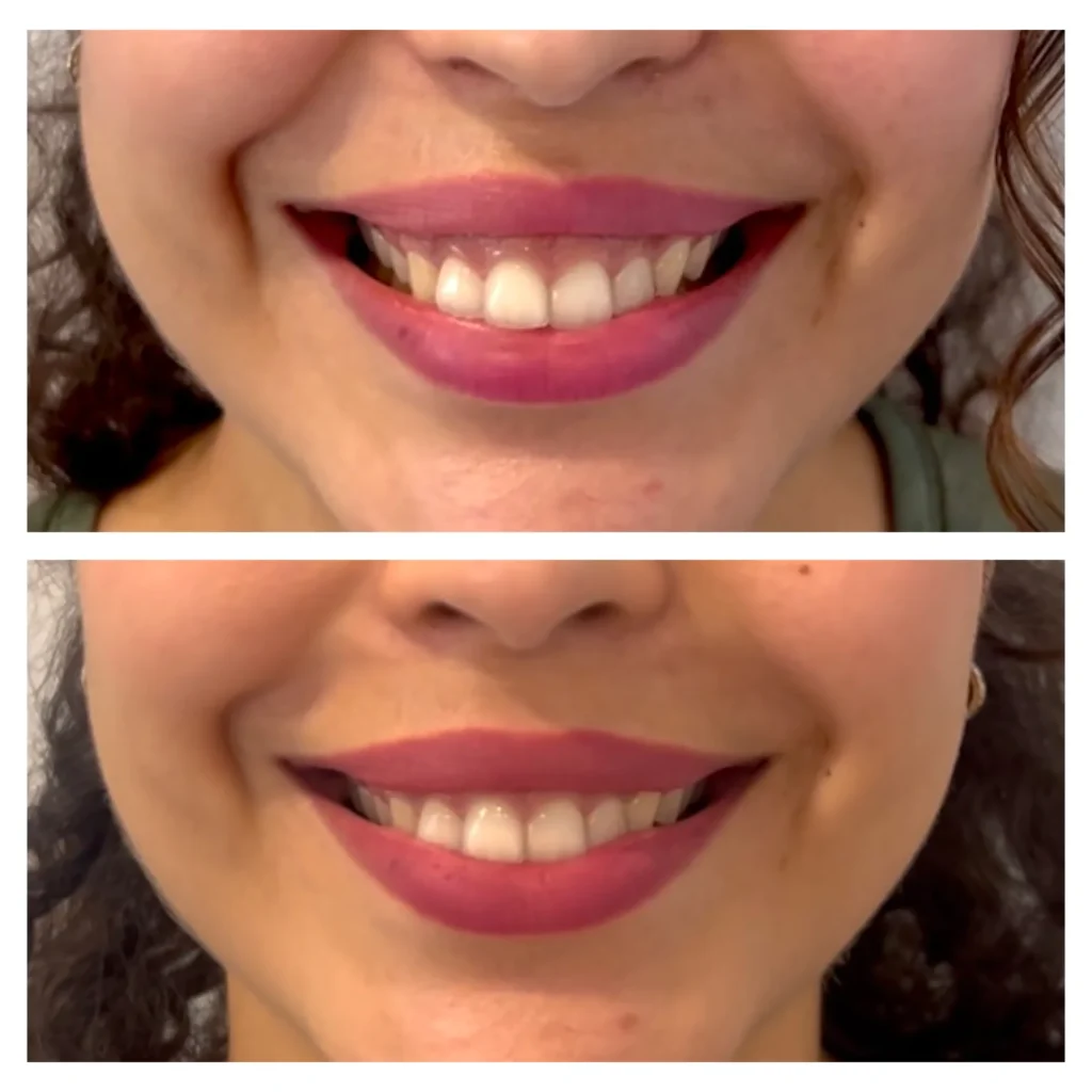 Gummy smile Botox before and after in Dubai by Dr. Azra Vaziri — less gum show when smiling