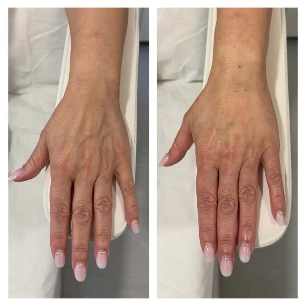Radiesse hand rejuvenation before and after in Dubai by Dr. Azra Vaziri — veins and tendons less prominent