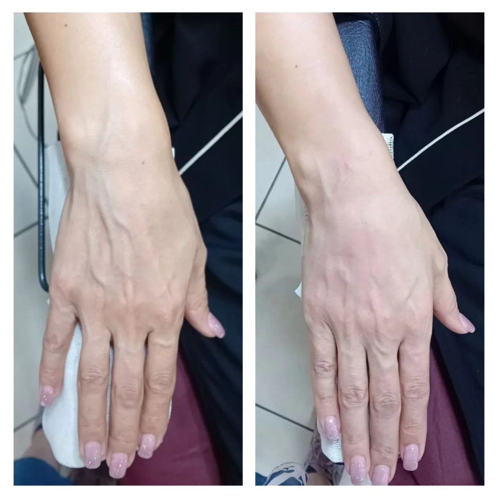 Radiesse hand rejuvenation before and after in Dubai by Dr. Azra Vaziri &mdash; tendons and veins less prominent